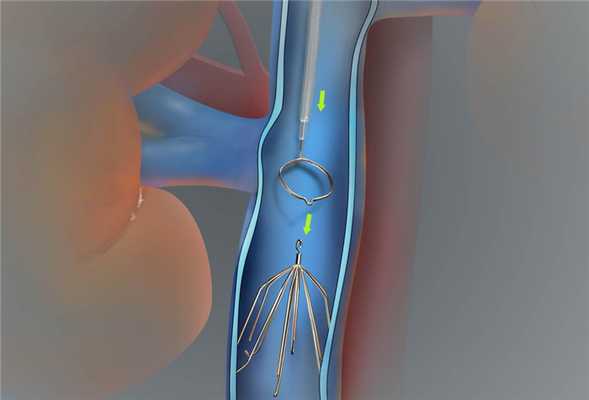 Кава-фильтр при тромбозе