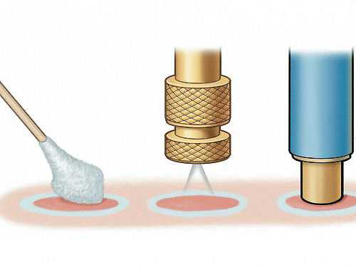 Насадки для криодеструкции