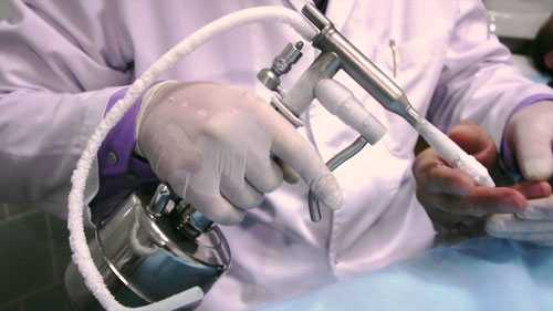 Криодеструкция жидким азотом