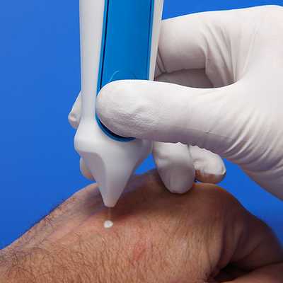 Криодеструкция новообразования жидким азотом