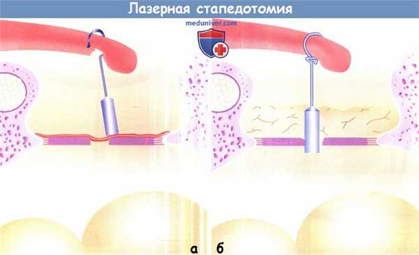 Лазерная стапедотомия