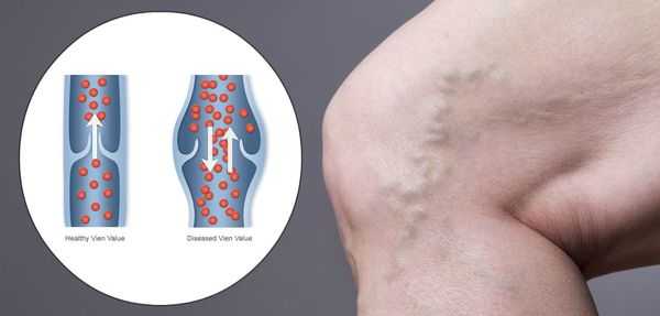 Нарушение венозного оттока