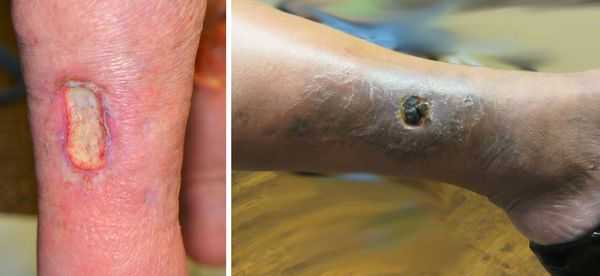 Трофическая язва