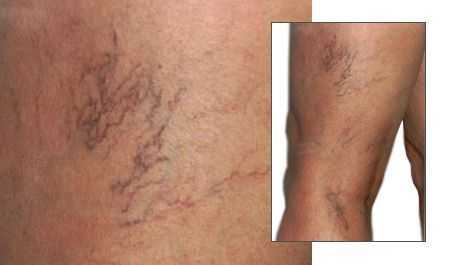 Варикозно-расширенные вены