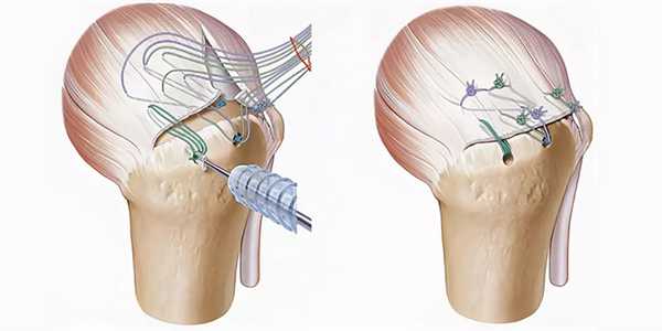 Артроскопический шов ротаторов плеча