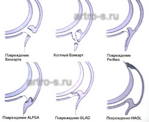 Варианты повреждения суставной губы