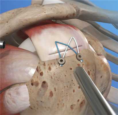 Артроскопический шов ротаторов плеча