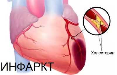Последствием закупорки артерий сердца становится инфаркт