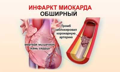 Инфаркт миокарда без зубца Q