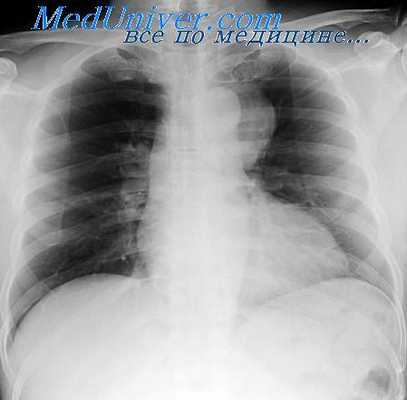 дермоидные кисты средостения