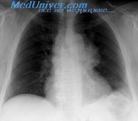 дермоиды и тератомы