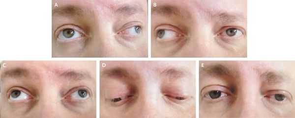 Резко выраженный нистагм