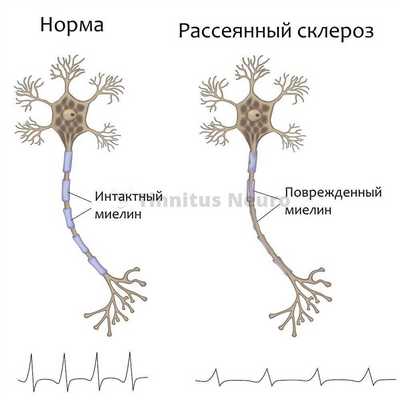 Патологическая импульсация и шум в ушах - следствие повреждения миелина при рассеянном склерозе