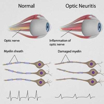 Изменение оболочки зрительного нерва