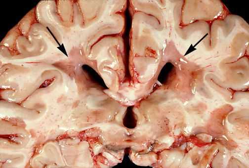 Образовавшиеся бляшки