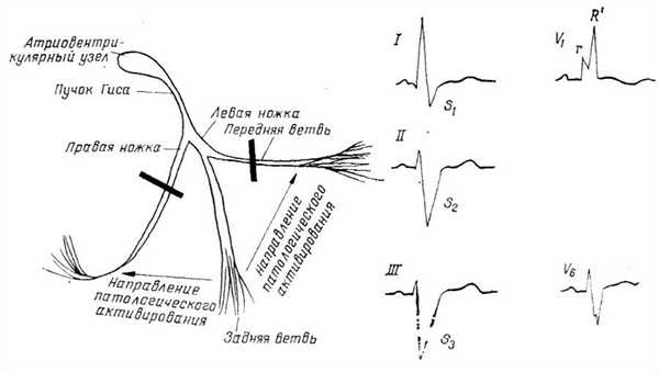 Блокада ножек пучка Гисса