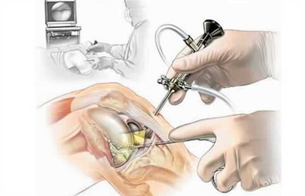 Артроскопия - самый современный и эффективный метод восстановления при разрыве ПКС.
