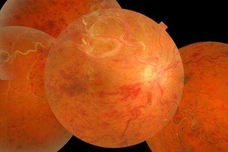 уйанберна-мейсона