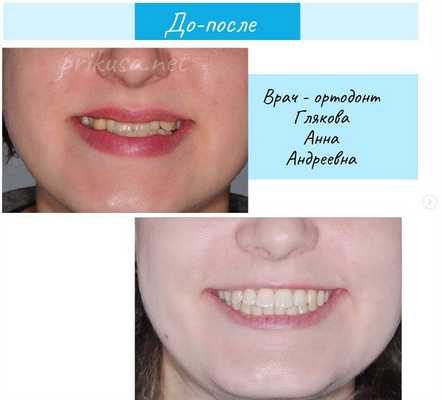 Дистальный прикус - фото