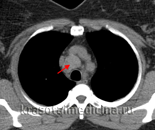 Лимфома средостения