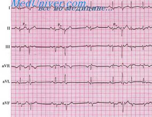 мерцание предсердий