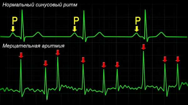 Как диагностировать мерцательную аритмию