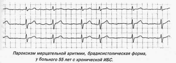 Виды мерцательной аритмии