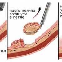 полипы желудка