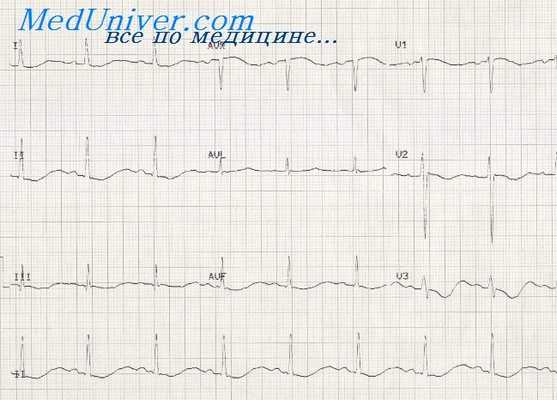 дистрофия миокарда