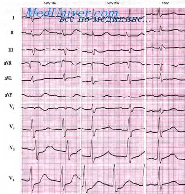 экг при стенокардии