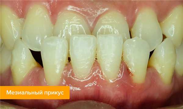 Фото мезиального прикуса