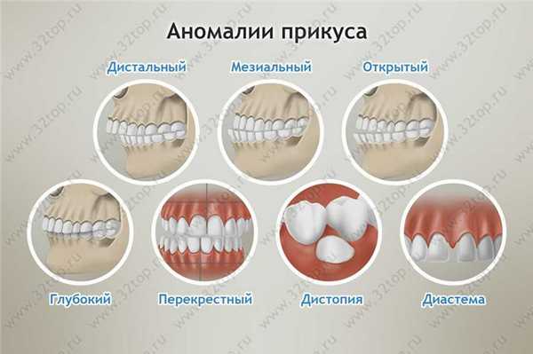 Аномалии прикуса