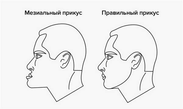Мезиальный и правильный прикус в картинках