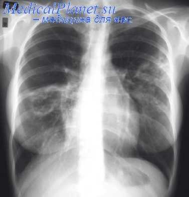 торакокаустика