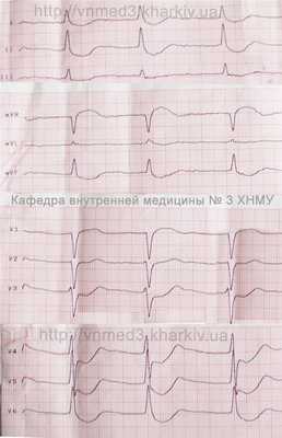 ecg2glic