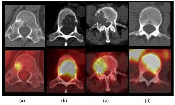 метастазы ПЭТ