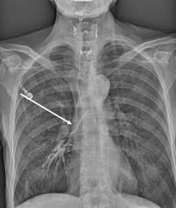 Свищ пищевода на рентгене