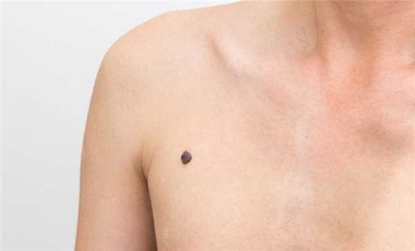 Узловая меланома