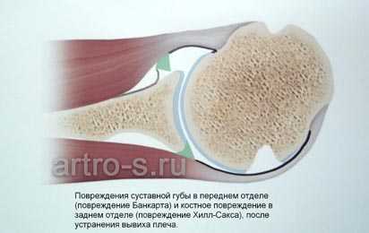 Повреждение суставной губы и повреждение Хилл-Сакса сохраняющиеся после устранения вывиха плеча