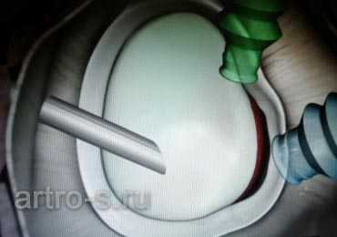 Артроскопическая картина повреждения Банкарта