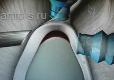 SLAP повреждение