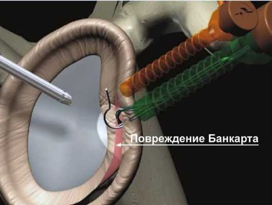 Артроскопическая операция Банкарта