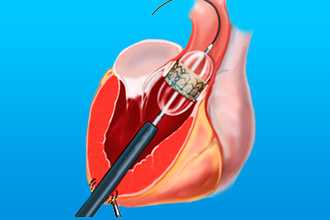 Баллонная вальвулопластика