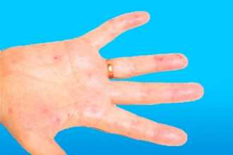 Лечение септического эндокардита