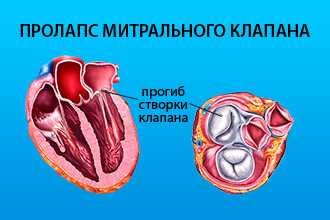 Порок митрального клапана
