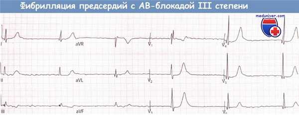 Фибрилляция предсердий с полной АВ-блокадой на ЭКГ