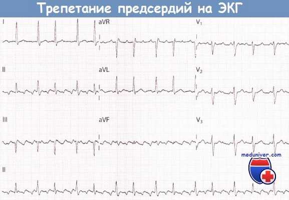 Трепетание предсердий на ЭКГ