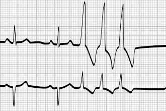 Как восстановить сердечный ритм при мерцательной аритмии