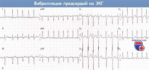 Фибрилляция предсердий на ЭКГ