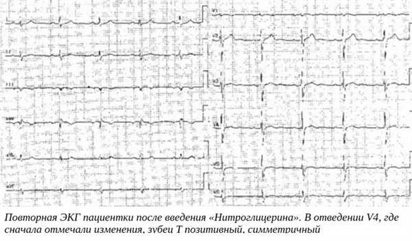 Повторная ЭКГ пациентки после введения «Нитроглицерина». В отведении V4, где сначала отмечали изменения, зубец T позитивный, симметричный